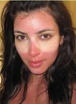 Snow_sunburn_1.jpg