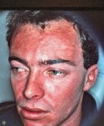 Snow_sunburn_2.jpg